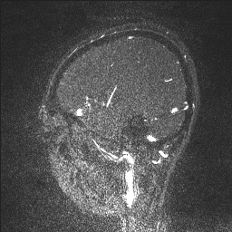 Cerebral tuberculosis with dural sinus invasion (Radiopaedia 60353-68090 Sagittal MRV 122).jpg