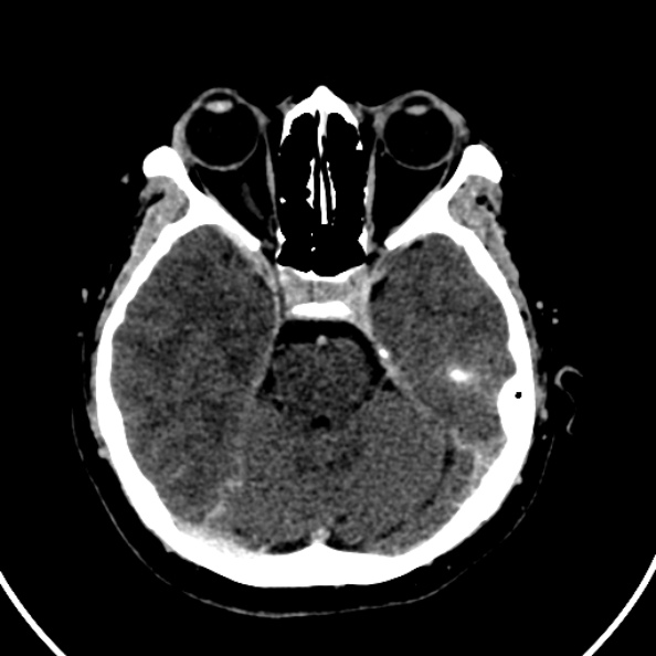 File:Cerebral venous hemorrhagic infarct from venous sinus thrombosis (Radiopaedia 55433-61883 Axial C+ delayed 102).jpg