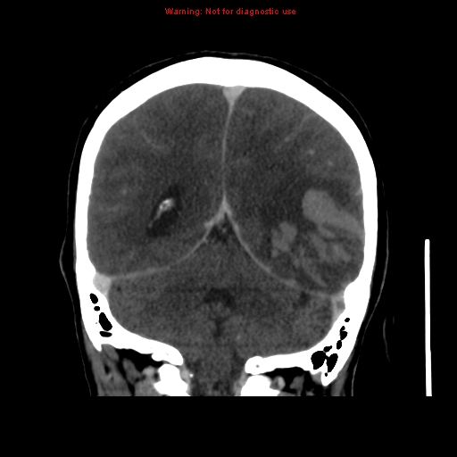 Cerebral venous infarction (Radiopaedia 12404-20735 B 57).jpg
