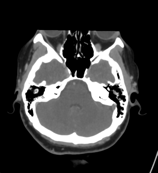 File:Cerebral venous infarction due to transverse sinus thrombosis (Radiopaedia 34688-36120 Axial CT venogram 15).png
