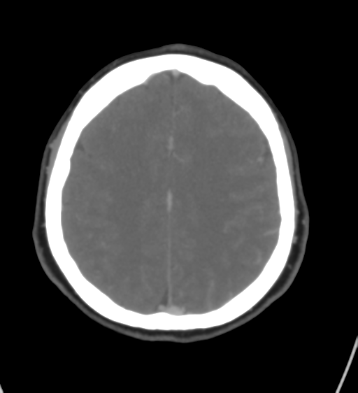 File:Cerebral venous infarction due to transverse sinus thrombosis (Radiopaedia 34688-36120 Axial CT venogram 36).png