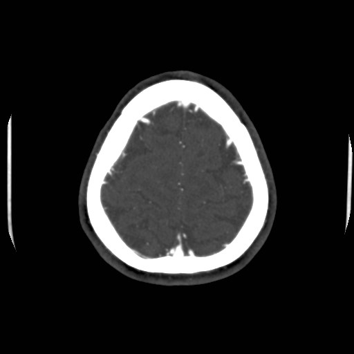 Cerebral venous sinus thrombosis (Radiopaedia 40619-43227 A 200).jpg
