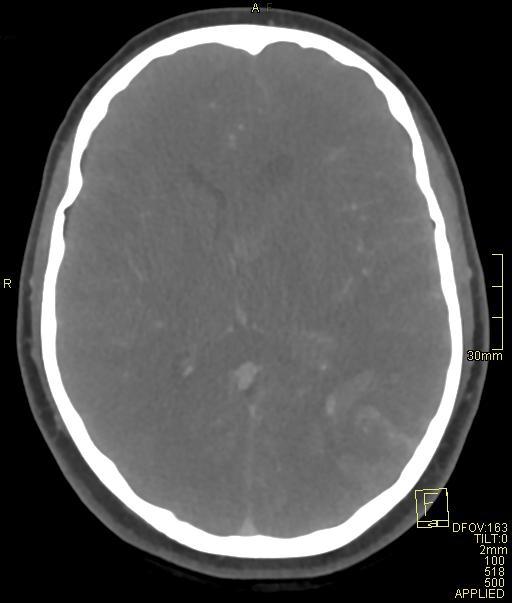 Cerebral venous sinus thrombosis (Radiopaedia 91329-108965 Axial venogram 45).jpg
