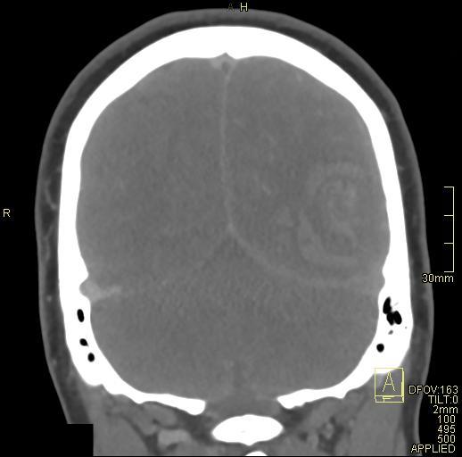 Cerebral venous sinus thrombosis (Radiopaedia 91329-108965 Coronal venogram 69).jpg