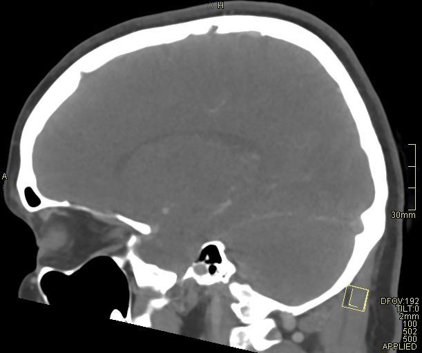 Cerebral venous sinus thrombosis (Radiopaedia 91329-108965 Sagittal venogram 29).jpg