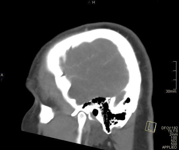 Cerebral venous sinus thrombosis (Radiopaedia 91329-108965 Sagittal venogram 66).jpg