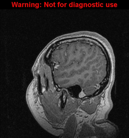 File:Cerebral venous thrombosis (Radiopaedia 37224-39208 Sagittal T1 C+ 127).jpg