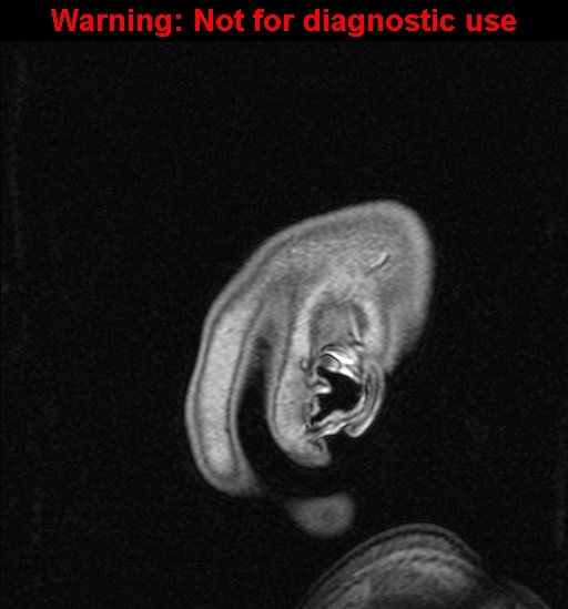 Cerebral venous thrombosis (Radiopaedia 37224-39208 Sagittal T1 C+ 2).jpg