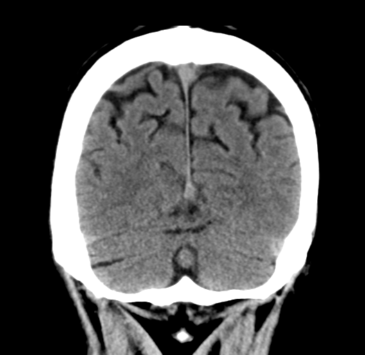 File:Cerebral venous thrombosis (Radiopaedia 38392-40467 Coronal non-contrast 31).png