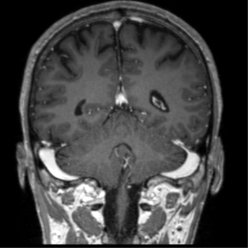 Cerebral venous thrombosis (Radiopaedia 38392-40469 Coronal T1 C+ 29).png