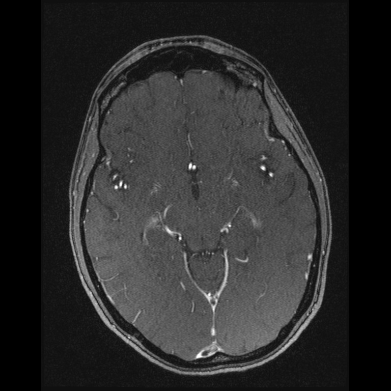 Cerebral venous thrombosis (Radiopaedia 45678-49854 Axial MRV 31).jpg