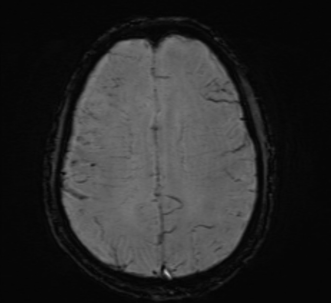 Cerebral venous thrombosis (Radiopaedia 71207-81504 Axial SWI 36).jpg