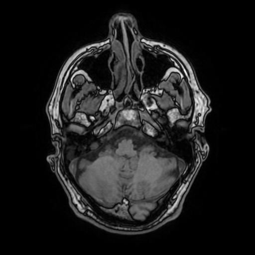 File:Cerebral venous thrombosis with secondary intracranial hypertension (Radiopaedia 89842-106957 Axial T1 51).jpg