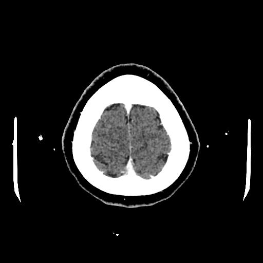 Cerebral venous thrombosis with venous hemorrhagic infarct (Radiopaedia 90354-107660 Axial with contrast 152).jpg