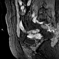 File:Cervical adenocarcinoma (Radiopaedia 65011-73985 E 4).jpg