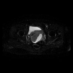 File:Cervical carcinoma (Radiopaedia 67644-77047 Axial DWI 38).jpg