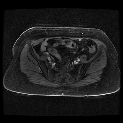 Cervical carcinoma (Radiopaedia 70924-81132 Axial T1 C+ fat sat 155).jpg