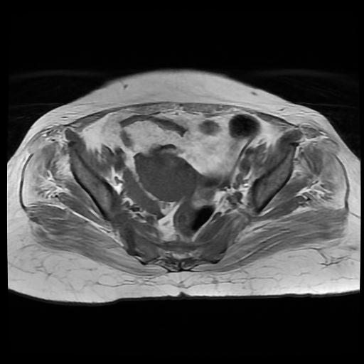 File:Cervical carcinoma (Radiopaedia 88010-104555 Axial T1 9).jpg