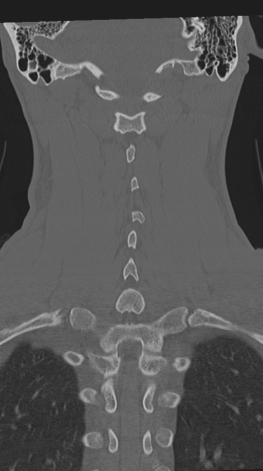 Cervical intercalary bone (Radiopaedia 35211-36748 Coronal bone window 54).png