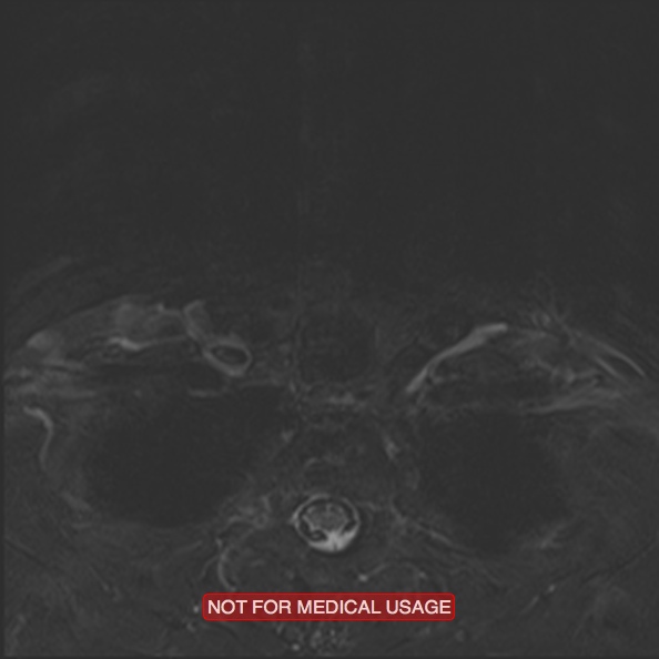 Cervical nerve schwannoma (Radiopaedia 27964-28221 C 47).jpg