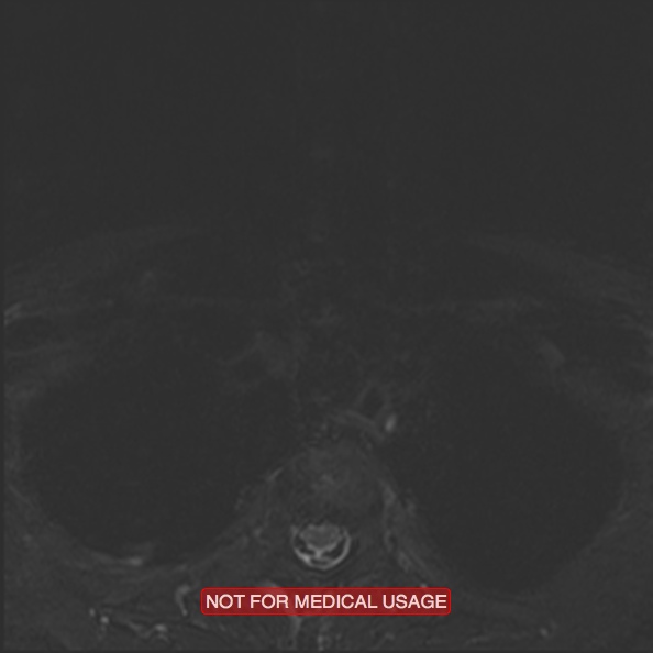 File:Cervical nerve schwannoma (Radiopaedia 27964-28221 C 50).jpg