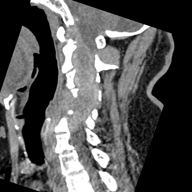 Cervical spinal neurofibroma in a patient with NF1 (Radiopaedia 58344-65464 C 23).jpg
