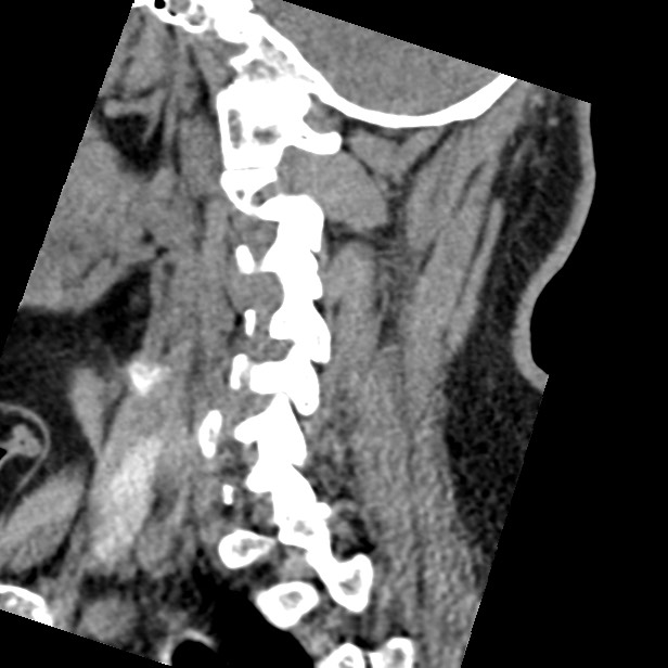 Cervical spinal neurofibroma in a patient with NF1 (Radiopaedia 58344-65464 C 37).jpg