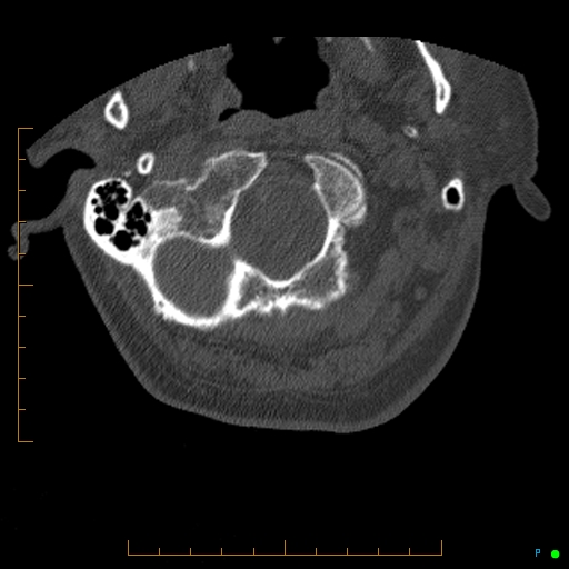 File:Cervical spine fracture - ankylosing spondylitis (Radiopaedia 76835-88706 Axial bone window 9).jpg