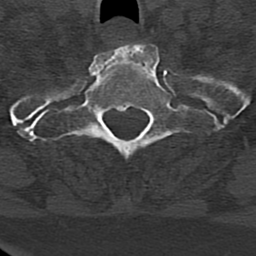 File:Cervical spine fracture - chalk stick (Radiopaedia 39116-41323 Axial bone window 80).png