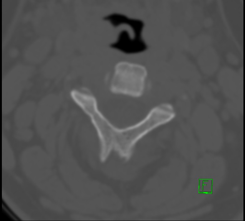 Cervical spine fracture - hyperflexion injury (Radiopaedia 66184-75364 Axial bone window 10).jpg