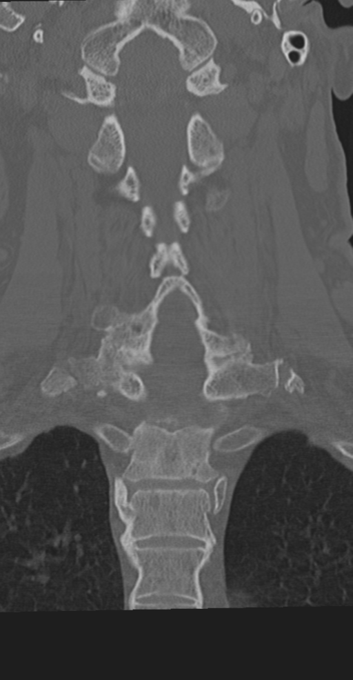 Cervical spine fracture in the setting of ankylosis (Radiopaedia 37038-38715 Coronal bone window 40).png