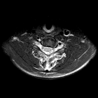 File:Cervical spine posterior ligamentous complex rupture (Radiopaedia 63486-72103 Axial T2 8).jpg