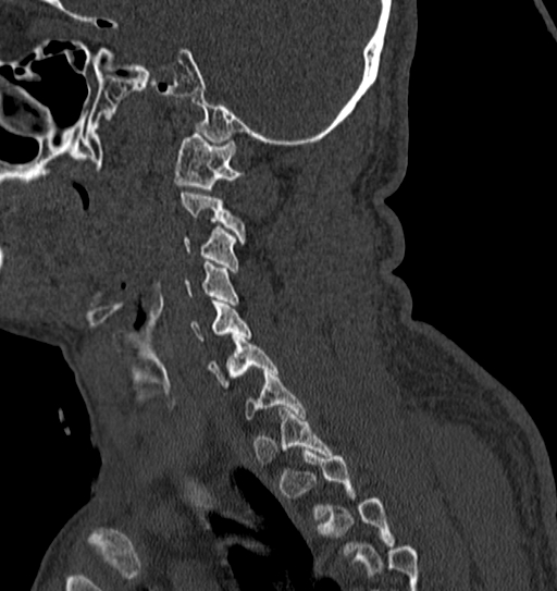 File:Cervical spine trauma with tear drop fracture and perched facet joint (Radiopaedia 53989-60127 Sagittal bone window 37).jpg