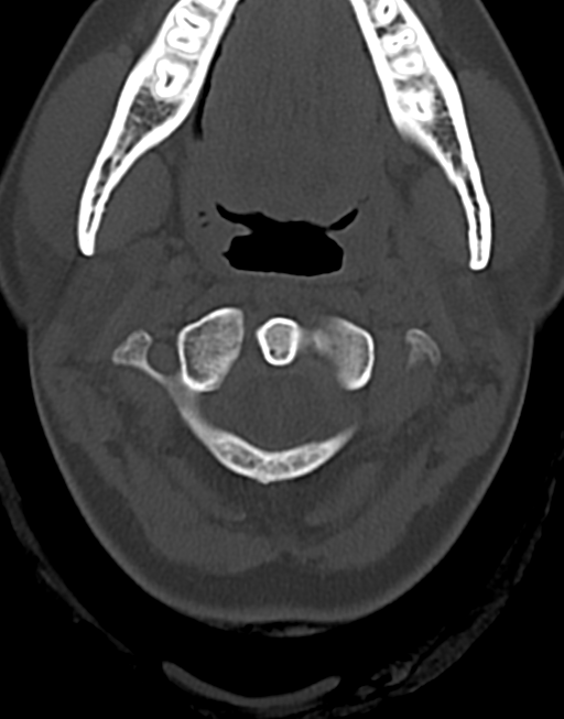 Cervical tuberculous spondylitis (Radiopaedia 39149-41365 Axial bone window 13).png