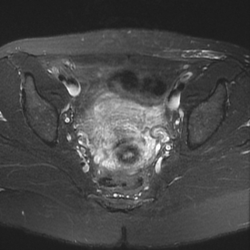 File:Cesarian section scar endometriosis (Radiopaedia 66520-75799 Axial T2 fat sat 13).jpg