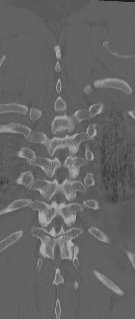 Chance fracture (Radiopaedia 33854-35020 Coronal bone window 70).png