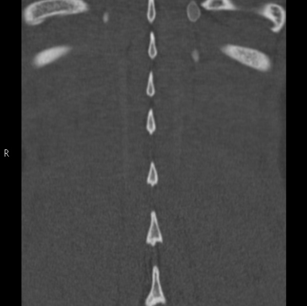 File:Chance fracture (Radiopaedia 36521-38081 Coronal bone window 59).jpg