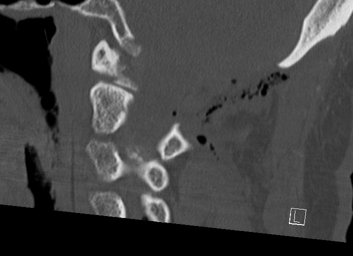Chiari I malformation with a symptomatic syrinx of the posterolateral medulla oblongata (Radiopaedia 42573-45707 A 35).jpg