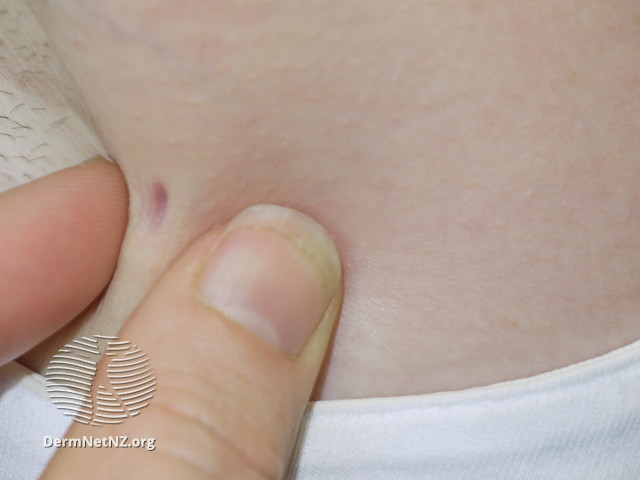 File:Chickenpox scars (DermNet NZ dermal-infiltrative-anetoderma03).jpg