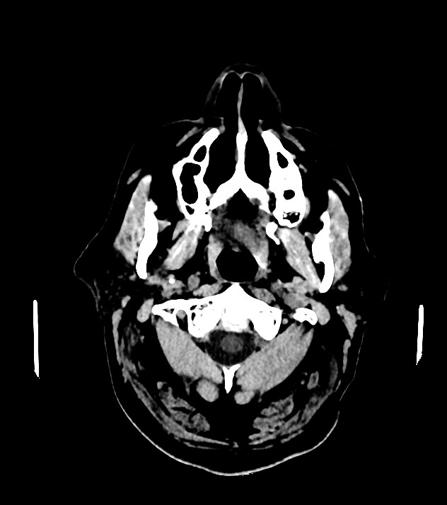 Cholangiocarcinoma with cerebral metastases (Radiopaedia 83519-98628 Axial non-contrast 4).jpg