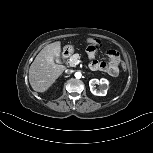 Cholecystoduodenal fistula due to calculous cholecystitis with gallstone migration (Radiopaedia 86875-103077 A 26).jpg