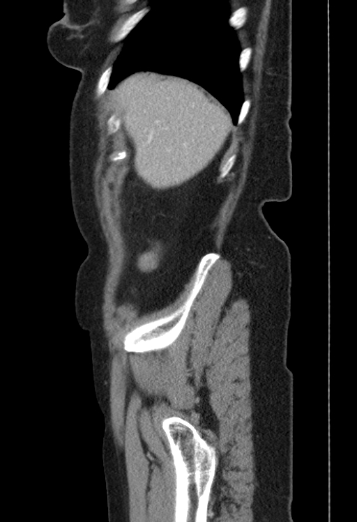 Cholecystoduodenal fistula due to calculous cholecystitis with gallstone migration (Radiopaedia 86875-103077 F 53).jpg