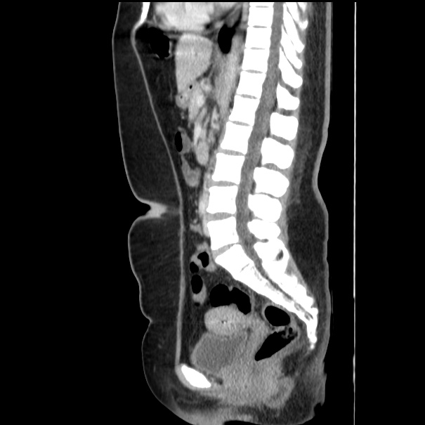 Choledocholithiasis on CT and MRI (Radiopaedia 24825-25087 D 33).jpg