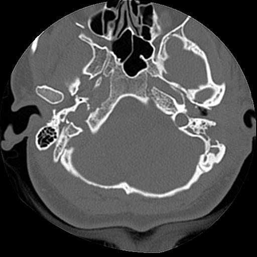 Cholesteatoma (Radiopaedia 84960-100474 Axial bone window 51).jpg