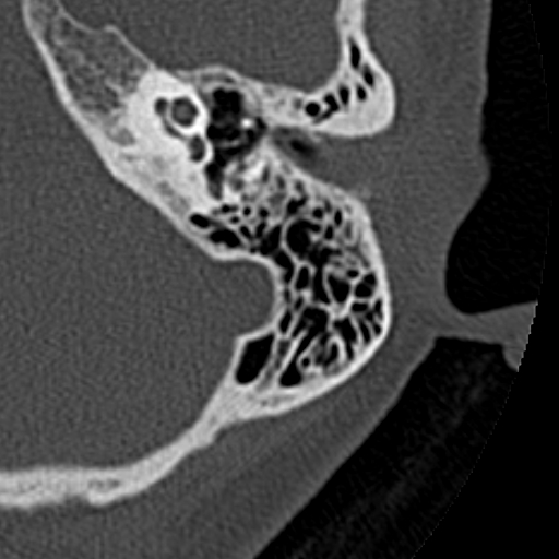 File:Cholesteatoma of the external ear (Radiopaedia 16540-16225 Axial bone window 21).jpg