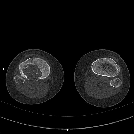 File:Chondroblastoma (Radiopaedia 62721-71030 Axial bone window 67).jpg