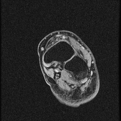 File:Chondroblastoma - midfoot (Radiopaedia 64831-73765 F 10).jpg