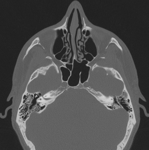 Chondrosarcoma (clivus) (Radiopaedia 46895-51425 Axial bone window 43).png
