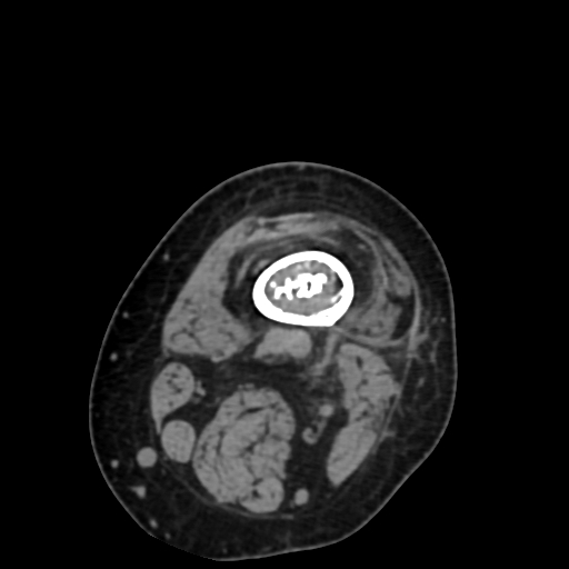 Chondrosarcoma - femur (Radiopaedia 64187-72954 Axial non-contrast 13).jpg
