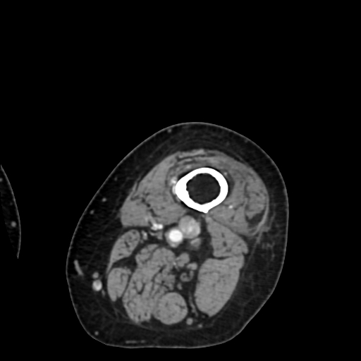 Chondrosarcoma - femur (Radiopaedia 64187-72954 Axial with contrast 2).jpg